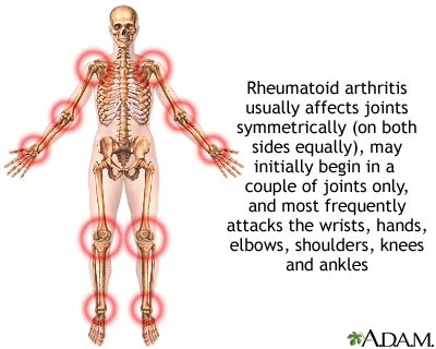 ra1