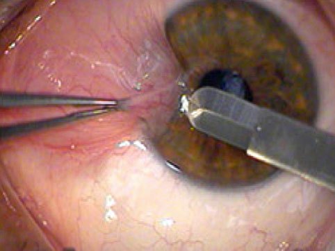 BIGdiagram pterygium 02.jpg