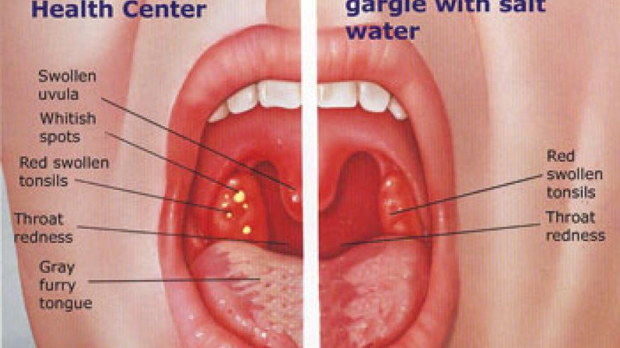 tonsillitis